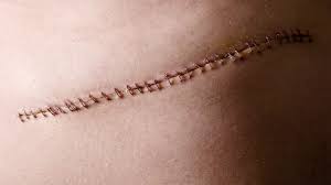 Scar Image